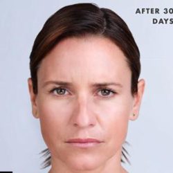 Xeomin® Before & After Patient #1581