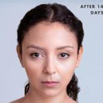 Xeomin Before & After Patient #1582