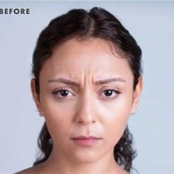 Xeomin® Before & After Patient #1582