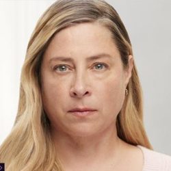 Botox® Before & After Patient #1578