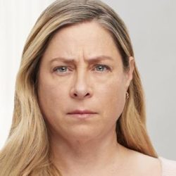 Botox® Before & After Patient #1578