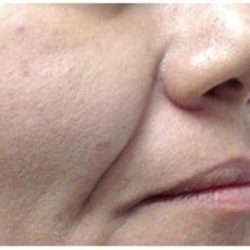 Fotona 4D Before & After Patient #1644