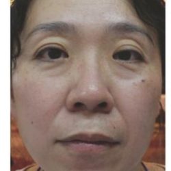 Fotona 4D Before & After Patient #1645
