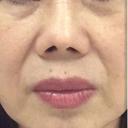 Fotona 4D Before & After Patient #1646