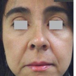 Fotona 4D Before & After Patient #1647