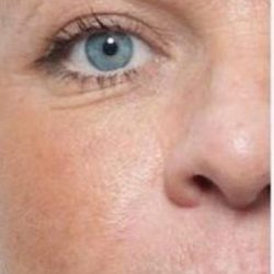 Fotona 4D Before & After Patient #1648
