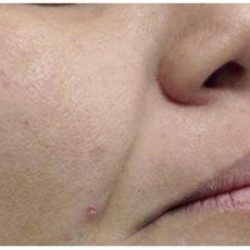 Fotona 4D Before & After Patient #1644