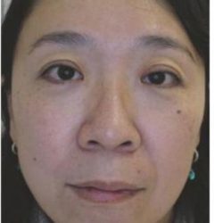 Fotona 4D Before & After Patient #1645