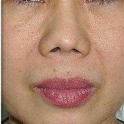 Fotona 4D Before & After Patient #1646