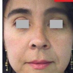 Fotona 4D Before & After Patient #1647
