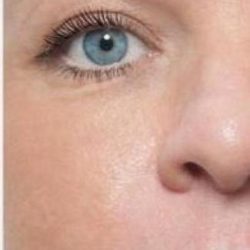 Fotona 4D Before & After Patient #1648
