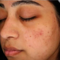 Glacial Skin Before & After Patient #1745