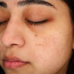 Glacial Skin Before & After Patient #1745