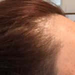 Hair Growth Treatment Before & After Patient #2063