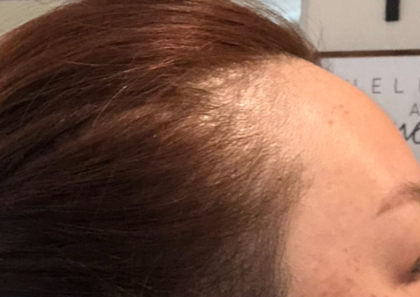 Hair Growth Treatment Before & After Patient #2063