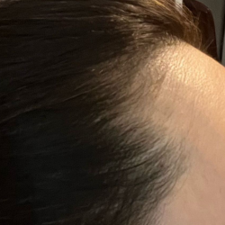 Hair Growth Treatment Before & After Patient #2063