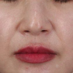Collagen Volume Before & After Patient #2073