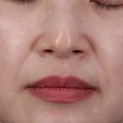 Collagen Volume Before & After Patient #2073