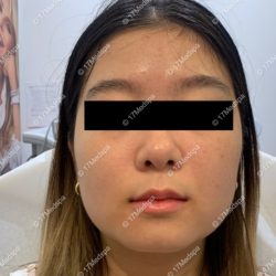 Jaw Slimming Before & After Patient #2080
