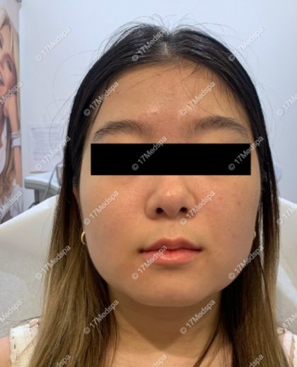 Masseter Botox Before & After Patient #2080