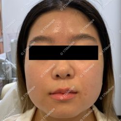 Jaw Slimming Before & After Patient #2080