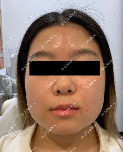 Masseter Botox Before & After Patient #2080