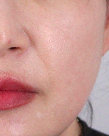 Lip Filler Before & After Patient #2073