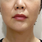 Cheek Filler Before & After Patient #2064