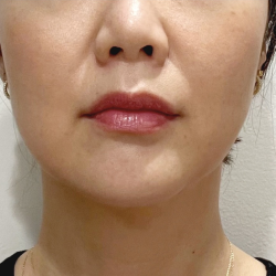 Ultherapy Before & After Patient #2064