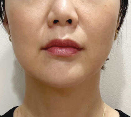 Cheek Filler Before & After Patient #2064