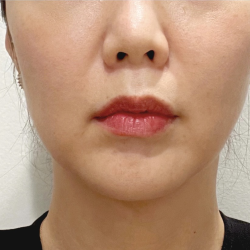 Ultherapy Before & After Patient #2064