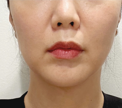 Cheek Filler Before & After Patient #2064