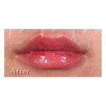 Lip Filler Before & After Patient #2070