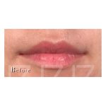 Lip Filler Before & After Patient #2070