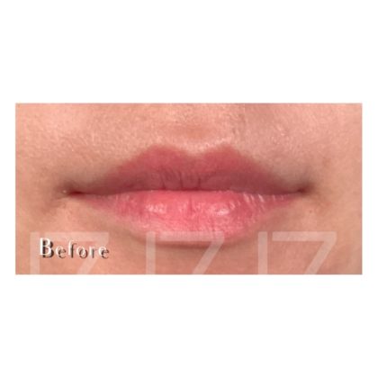 Lip Filler Before & After Patient #2070