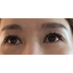 Under Eye Filler Before & After Patient #2316