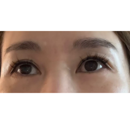 Under Eye Filler Before & After Patient #2316