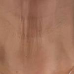 Skinvive Before & After Patient #2333