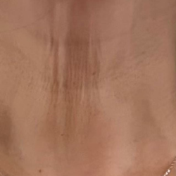 Skinvive® Before & After Patient #2333