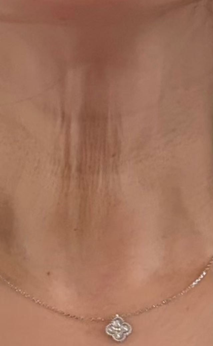 Skinvive Before & After Patient #2333