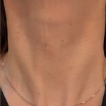 Skinvive Before & After Patient #2333