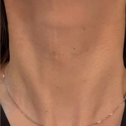 Skinvive® Before & After Patient #2333