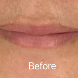 Lip Filler Before & After Patient #2354