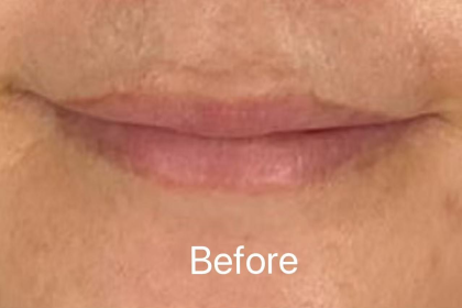 Lip Filler Before & After Patient #2354
