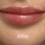 Lip Filler Before & After Patient #2354