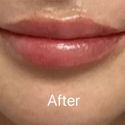 Lip Filler Before & After Patient #2354