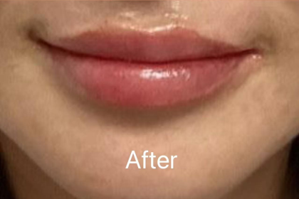 Lip Filler Before & After Patient #2354