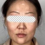 Radiesse Before & After Patient #2370