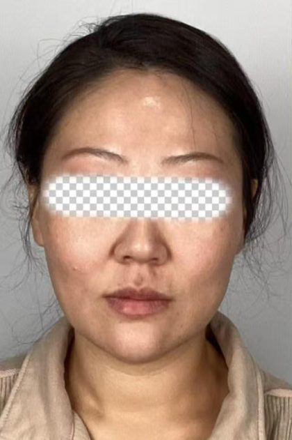 Radiesse Before & After Patient #2370