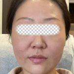 Radiesse Before & After Patient #2370